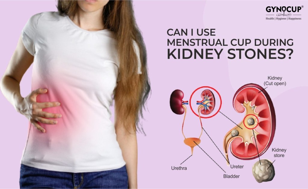 Picture of: Can I Use Menstrual Cup During Kidney Stones? Know Here– GynoCup