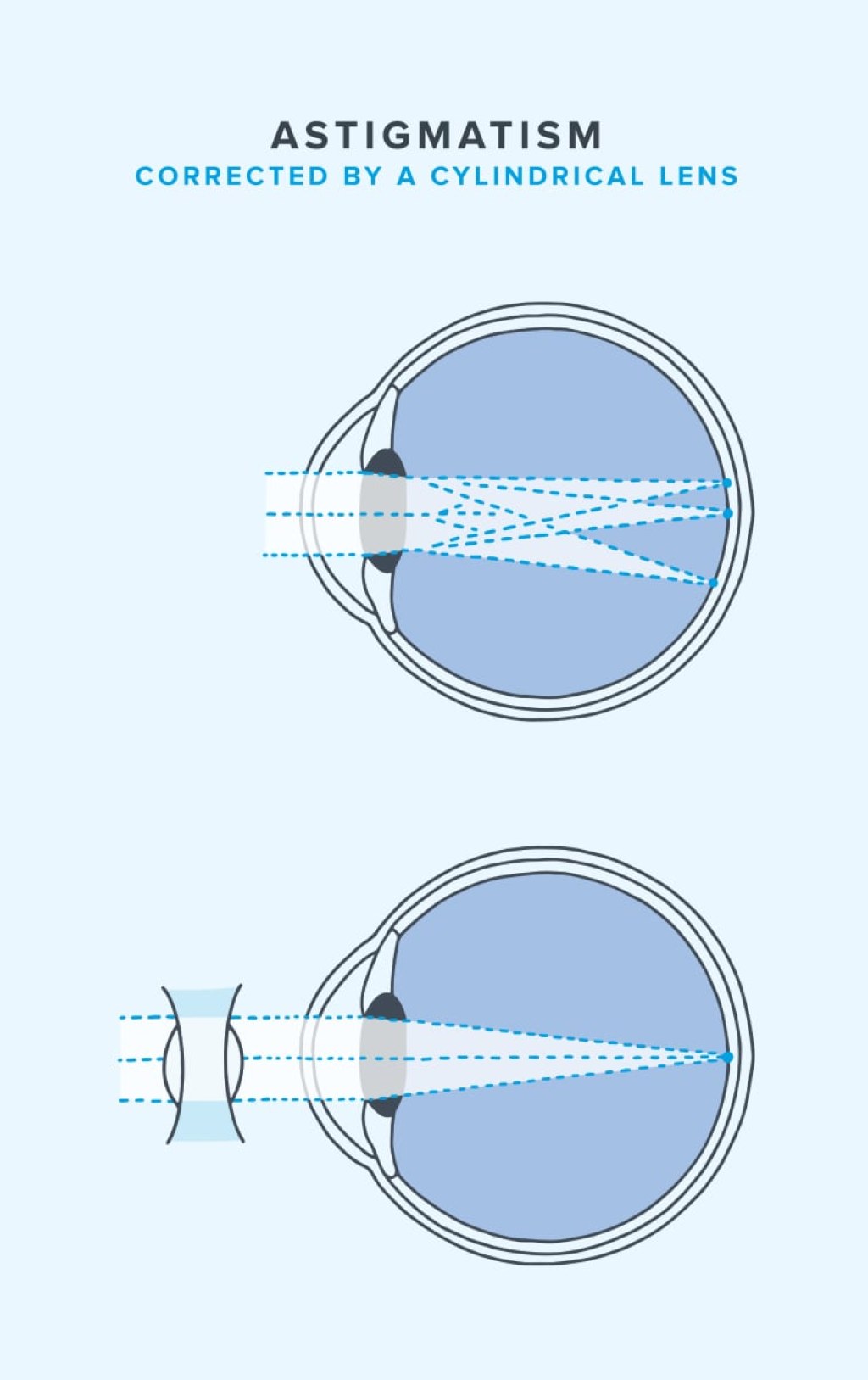 Picture of: Can You Wear Contacts With Astigmatism?  Warby Parker