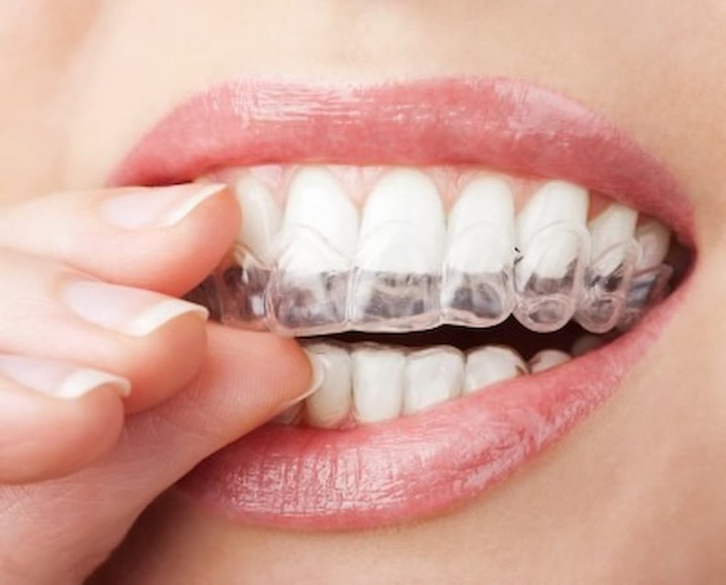 Picture of: Wearing Invisalign Only At Night?  Aesthetic Dental Partners